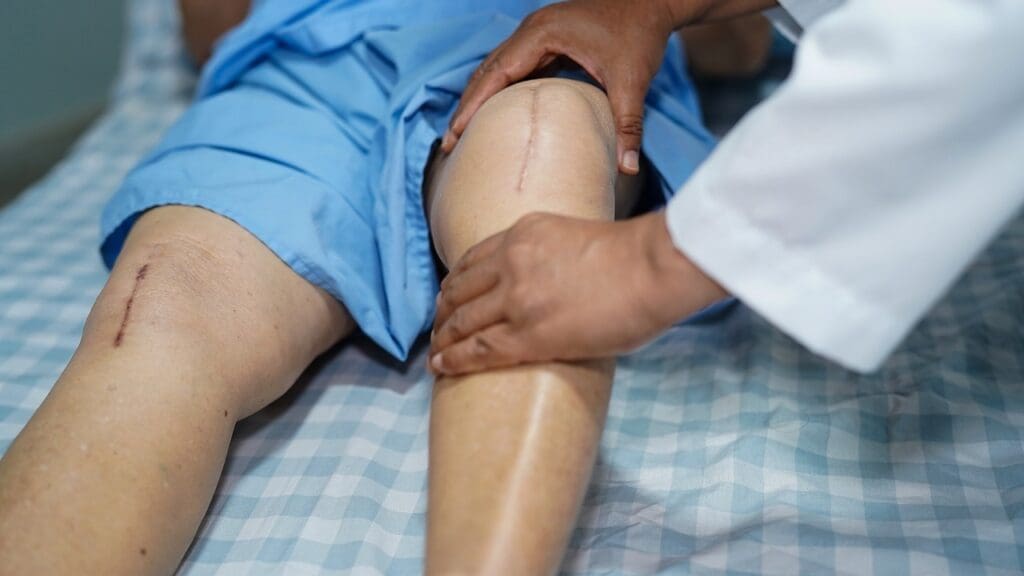 Knee Arthroscopy Stitches Knee Arthroscopy Stitches