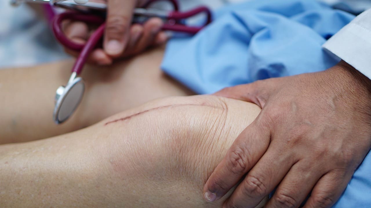 Knee Arthroscopy Stitches