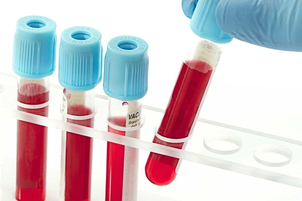 Where To Get a Blood Test: Labs & Procedures Explained