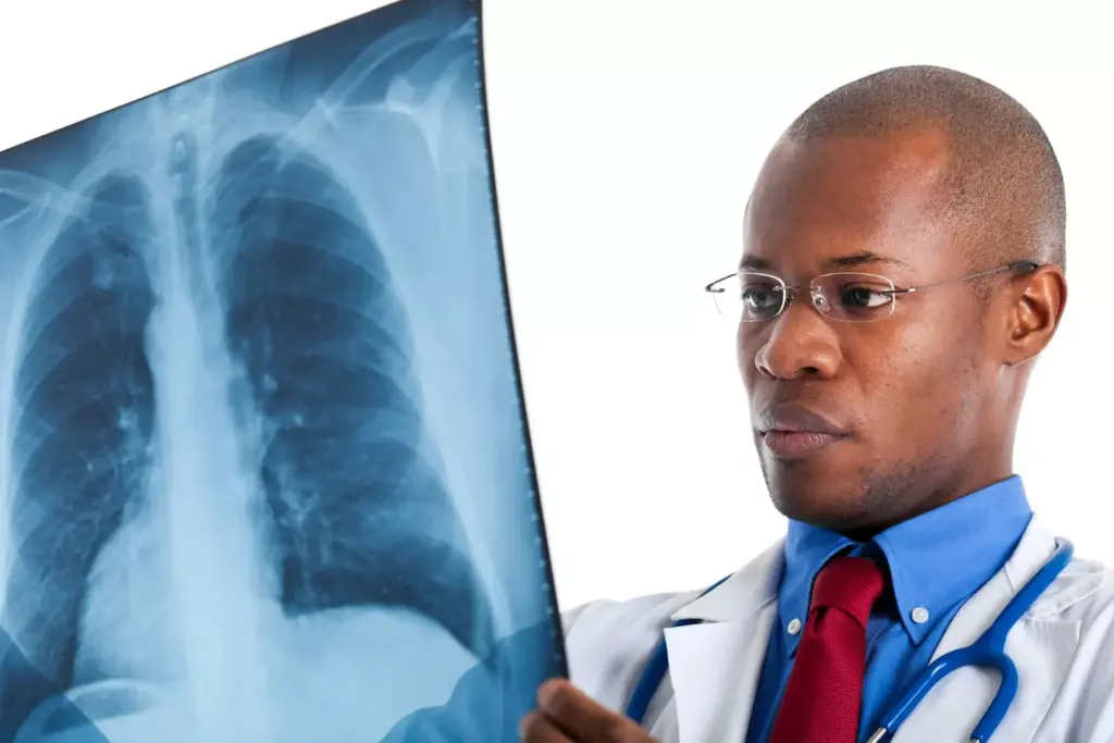 squamous carcinoma lung