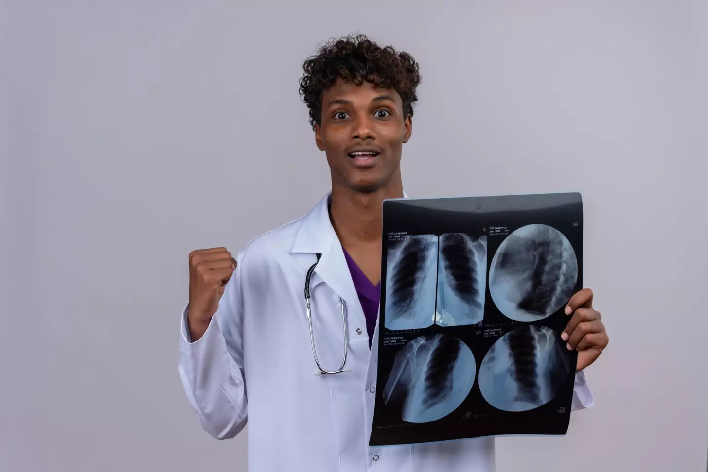 What Is Squamous Cell Lung Cancer and How Does It Differ from Other Types?