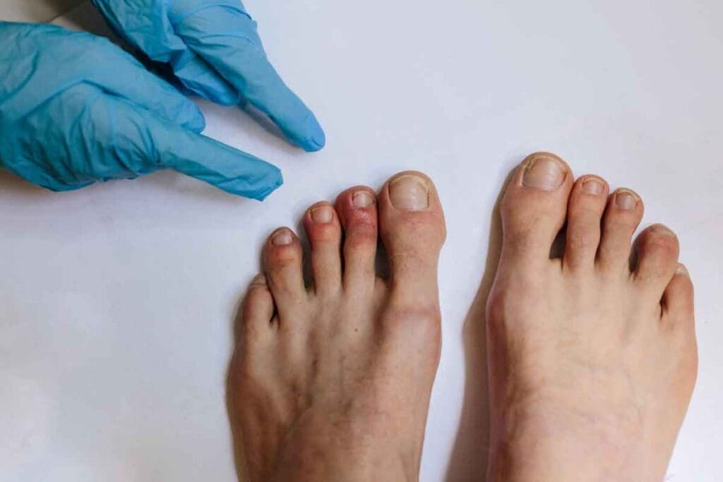 How to Recognize and Treat a Clot in Toe: Symptoms and Steps