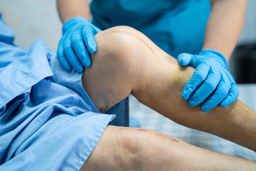 A knee joint in the post-operative stage
