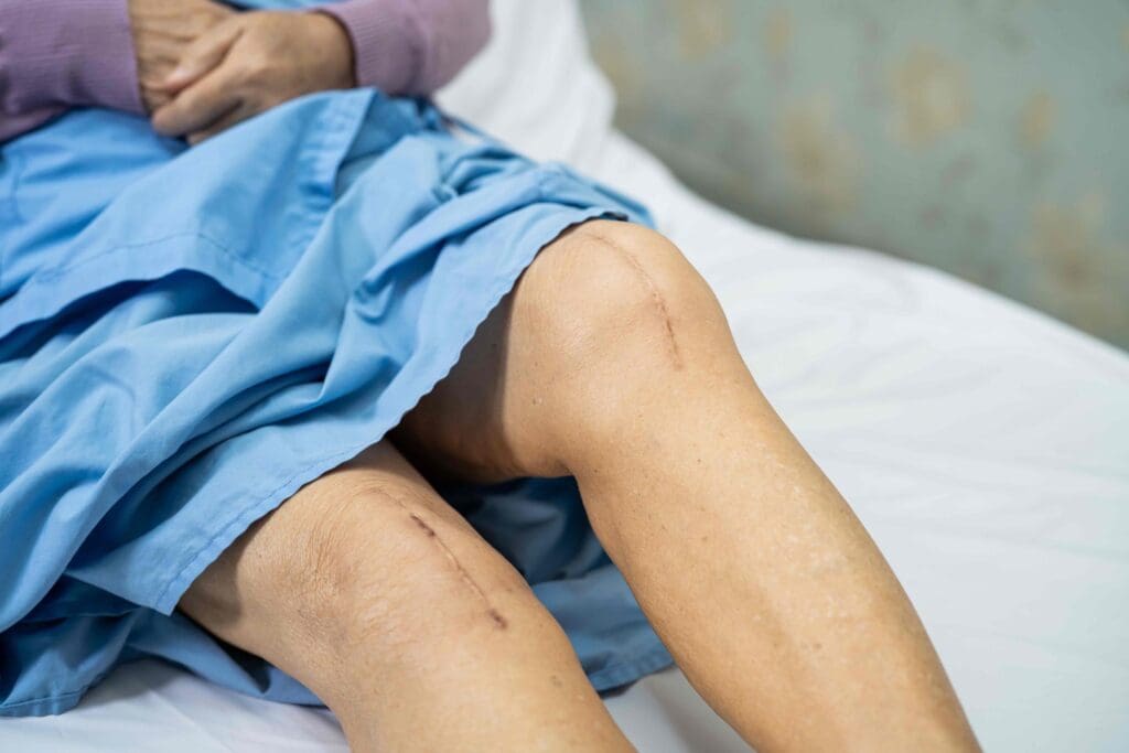 A swollen knee resting on a soft, white bedsheet A swollen knee resting on a soft, white bedsheet