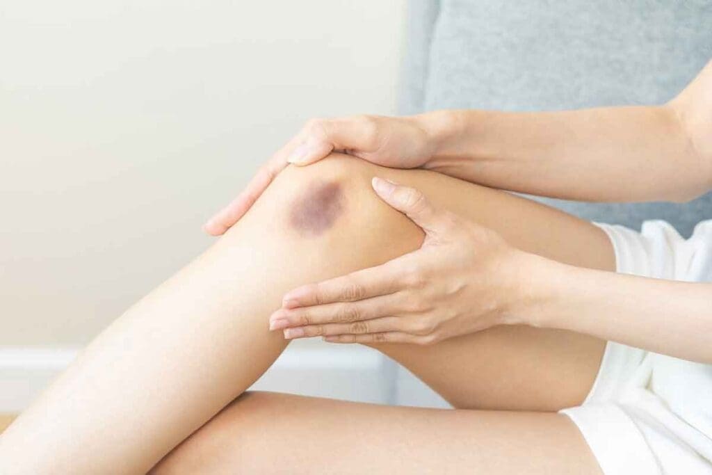 How Can You Tell If It's a DVT Bruise or Just a Bruise? Key Differences and Signs