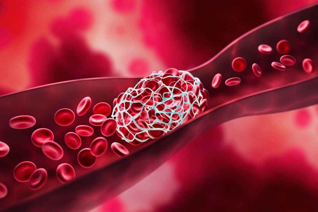 Blood Thinners and Bruising Pictures: What to Expect 2 Blood Thinners and Bruising Pictures: What to Expect