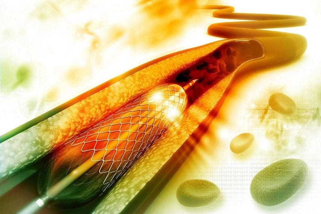 7 Key Facts About Apixaban Use Associated With Cancer: Dosing, Trials, and Best Options 2 7 Key Facts About Apixaban Use Associated With Cancer: Dosing, Trials, and Best Options