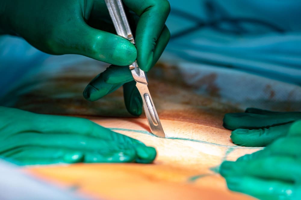Mohs Basal Cell Surgery: 7 Key Facts You Need to Know