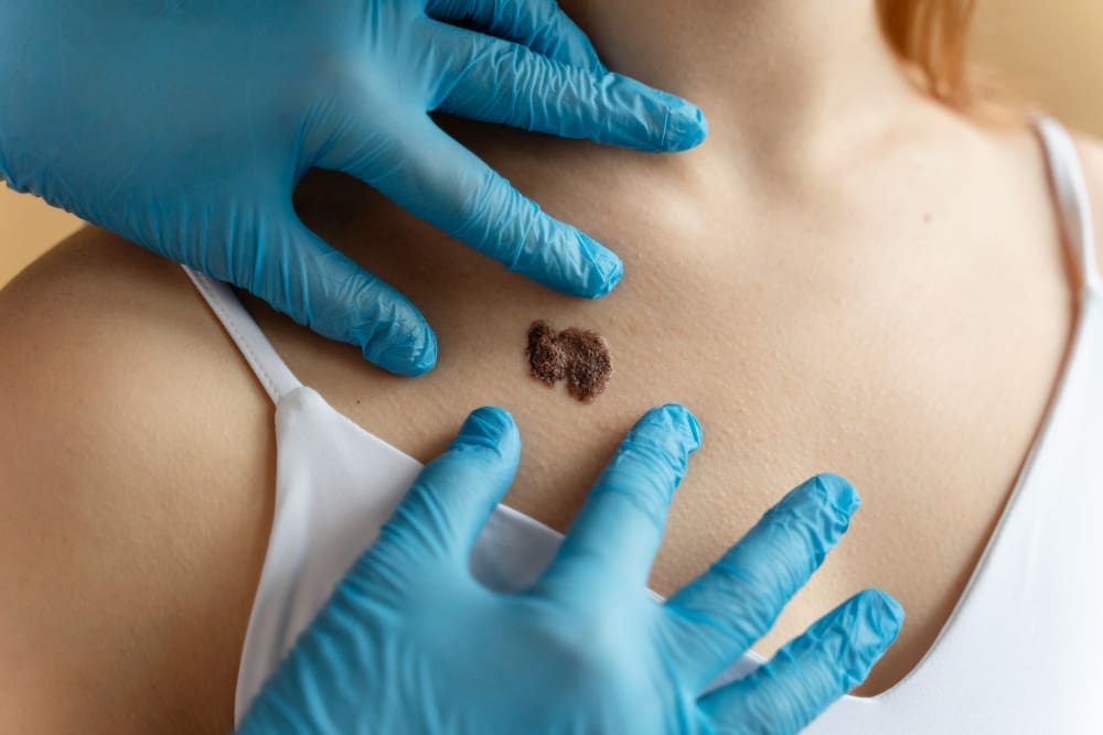 skin cancer surgery