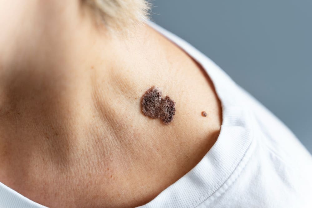 basal cell carcinoma basal cell carcinoma