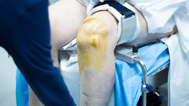 Recovery Time for Arthroscopic Knee Surgery: 7 Key Facts You Should Know