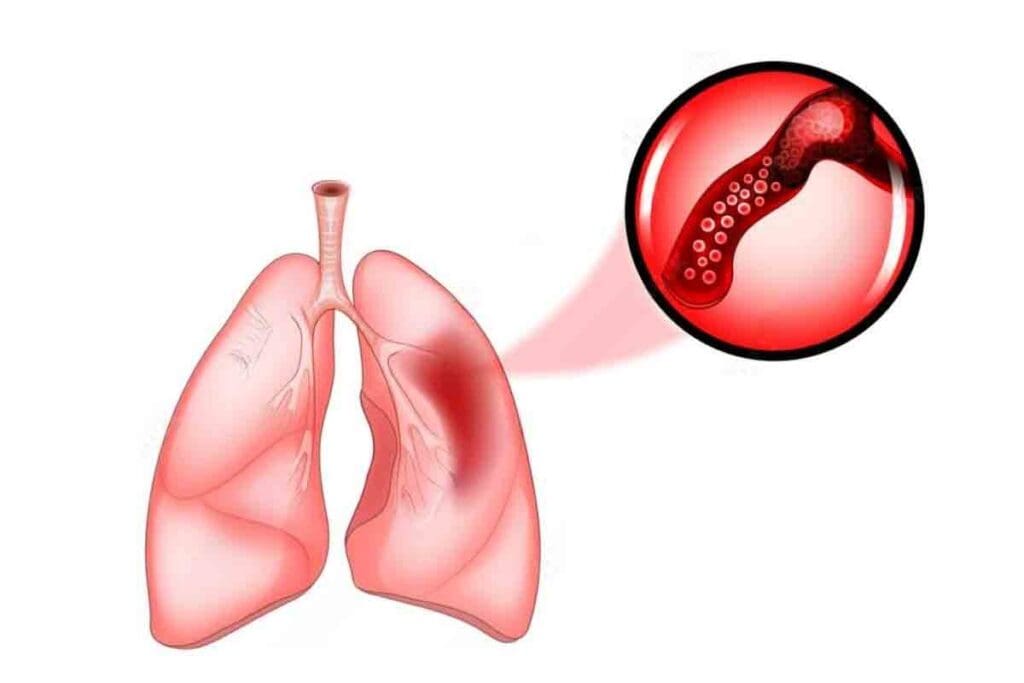 Blood in Lungs: 5 Critical Facts About Pulmonary Hemorrhage Causes and Symptoms
