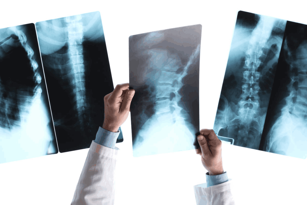 Weight Bearing Exercises for Bone Density