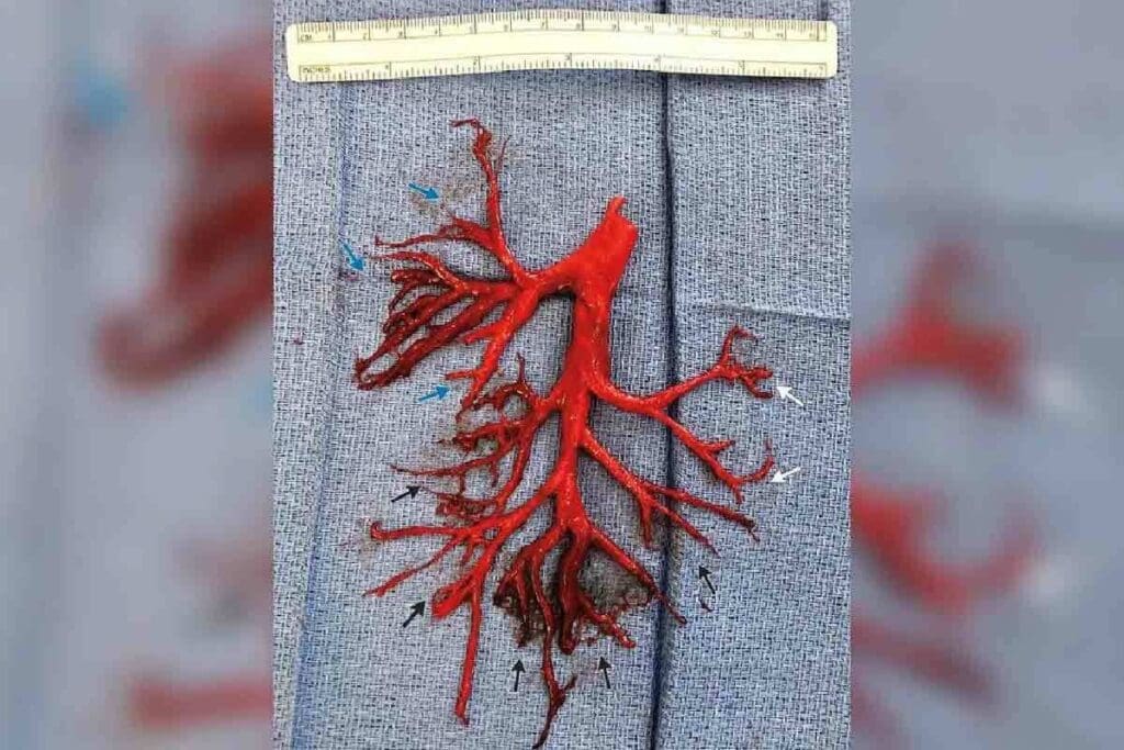 Blood Clot in Arm: 7 Key Symptoms and Risks You Should Know 2 Blood Clot in Arm: 7 Key Symptoms and Risks You Should Know