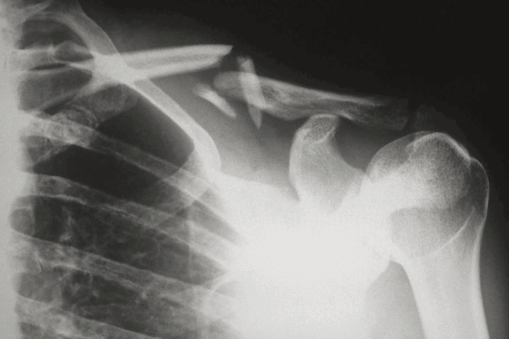 Fracture Healing Interference Causes 1 Fracture Healing Interference Causes