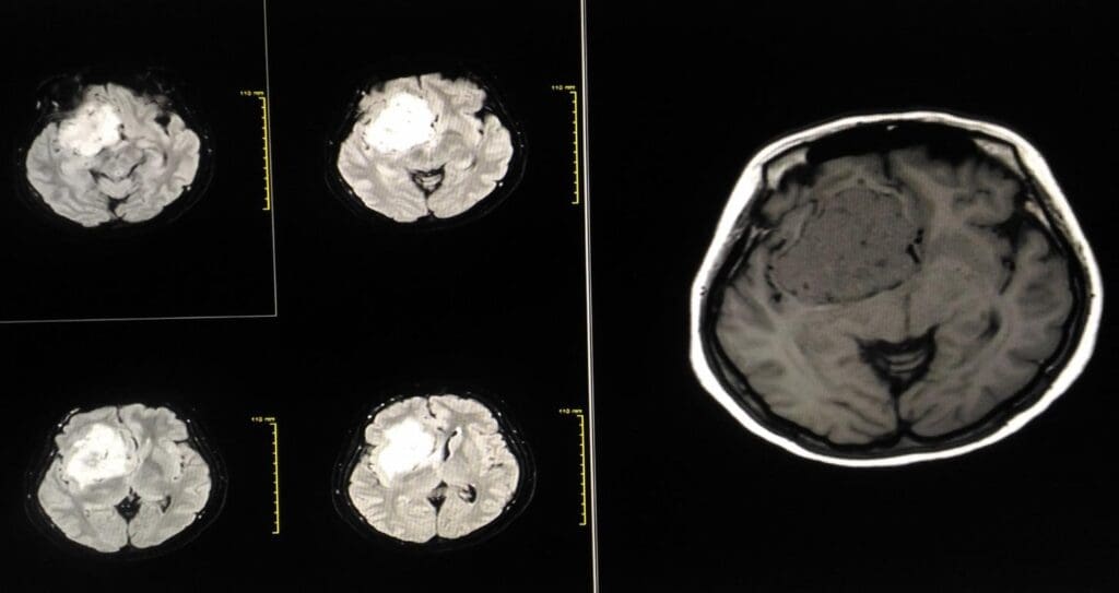 Recognizing Bulging Disc Herniated Disc Symptoms