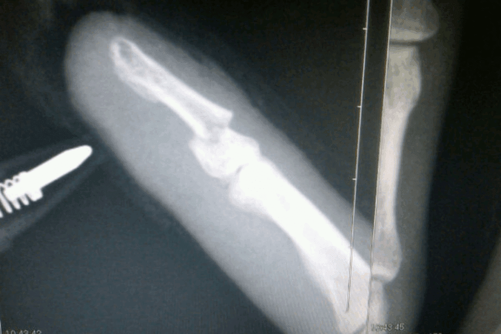 Fractured Finger Treatment and Recovery