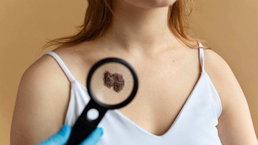 basal skin cancer removal
