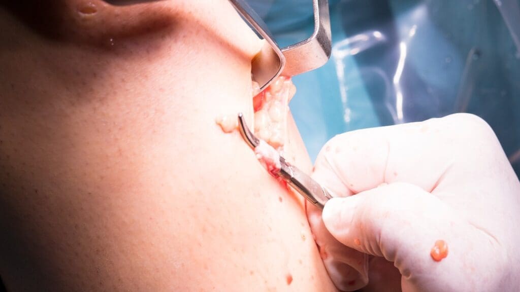 Skin Cancer Removal Surgeries