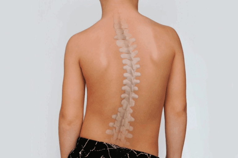 Avoiding Activities with Scoliosis: What to Skip