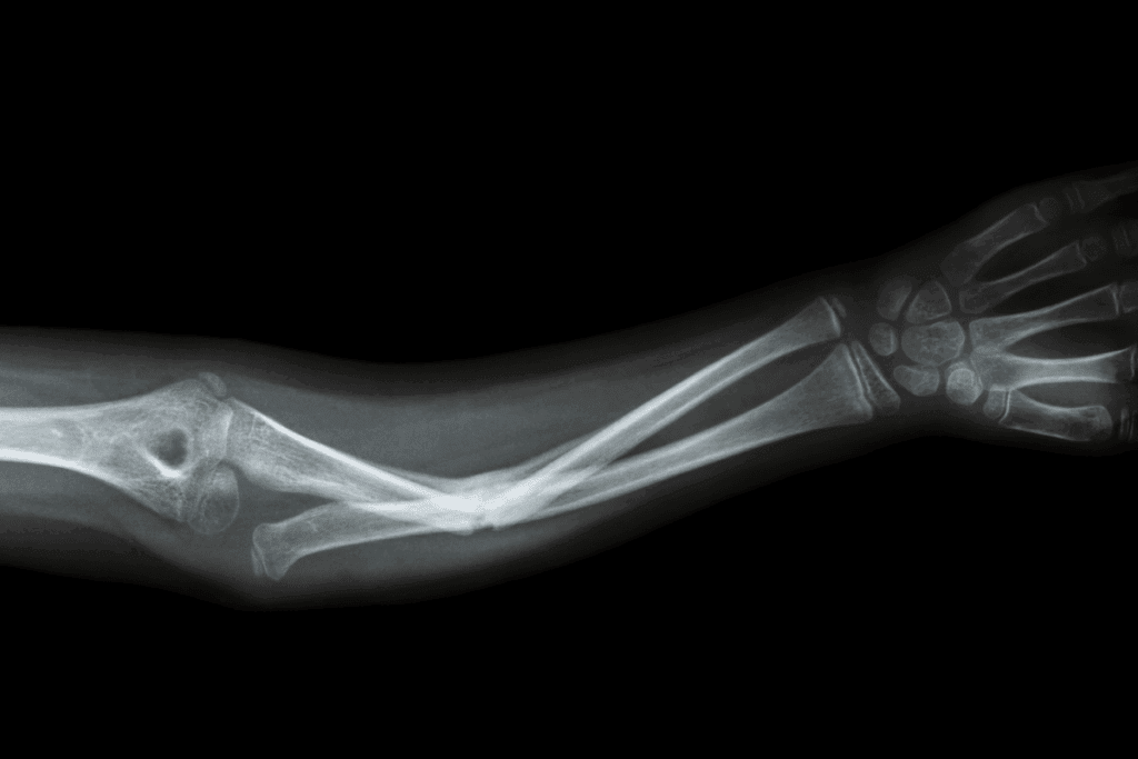 Worsening Fracture Signs to Watch For