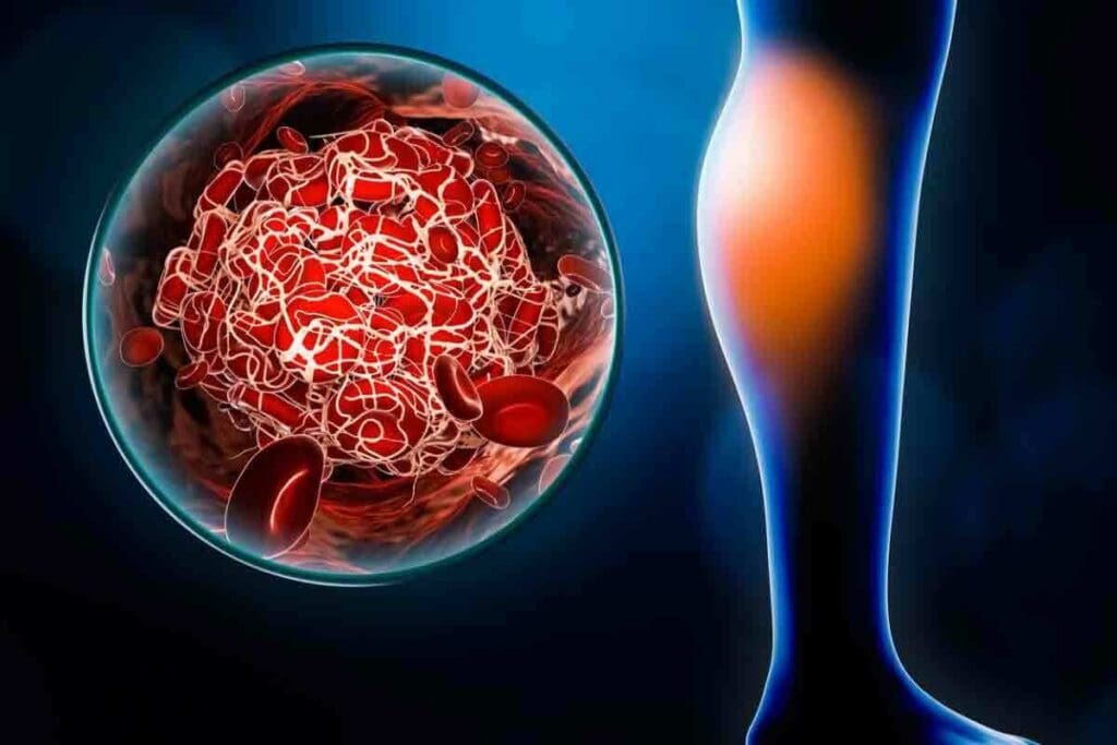 Clot on Hand: 7 Symptoms and When to Get Help