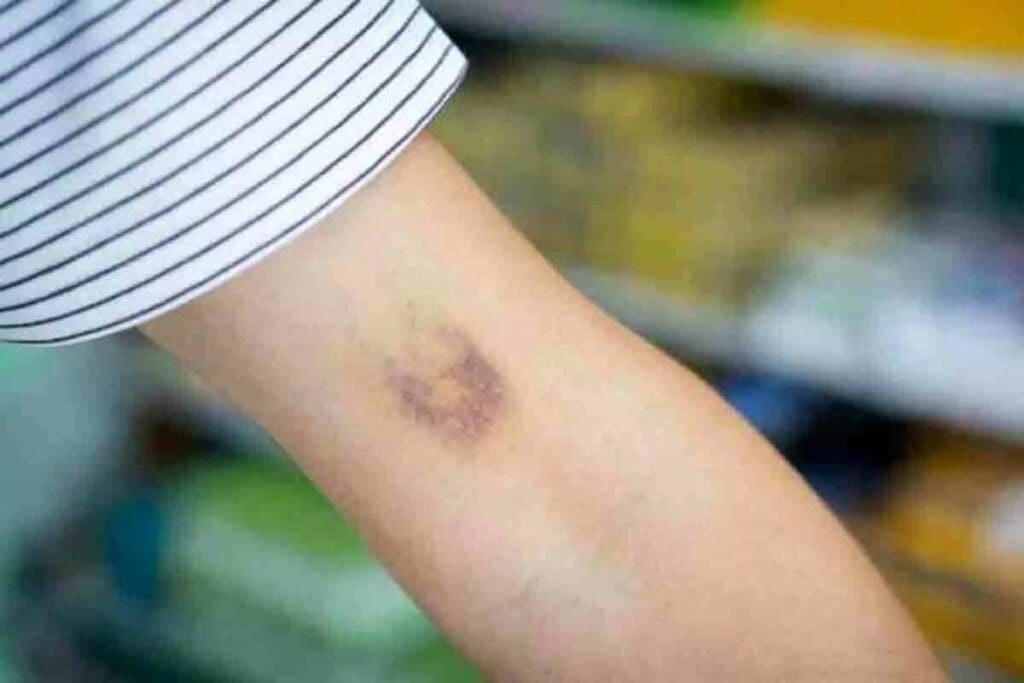 Blood Clot in Wrist: Symptoms and How Serious They Are 3 Blood Clot in Wrist: Symptoms and How Serious They Are