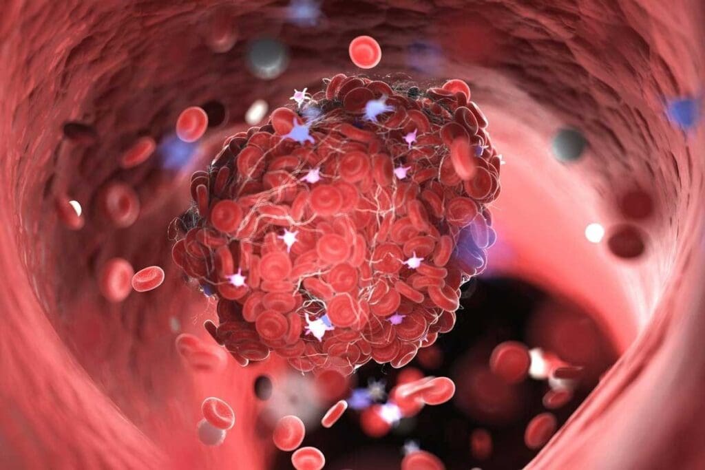 Clotting Disorder Pregnancy: 7 Key Causes and Effective Management Tips 1 image 4193 LIV Hospital