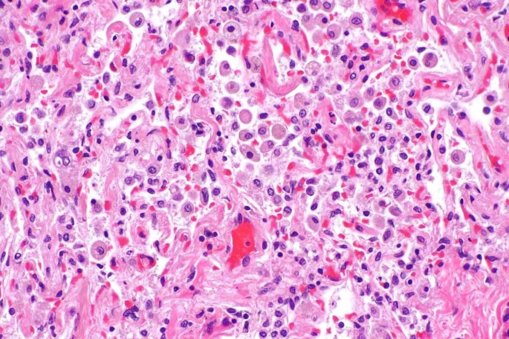 Can Bone Marrow Cancer Be Cured? Treatment Options, Outlook, and Symptoms Explained