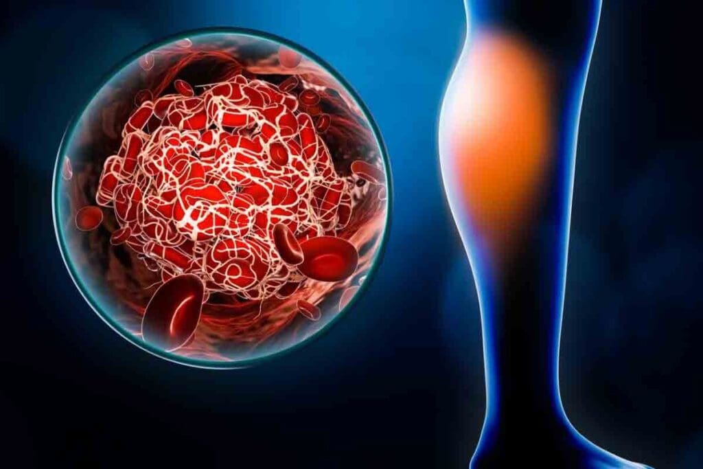 How Can You Tell If You Have a Blood Clot in Your Arm? Key Signs, Symptoms, and What It Feels Like