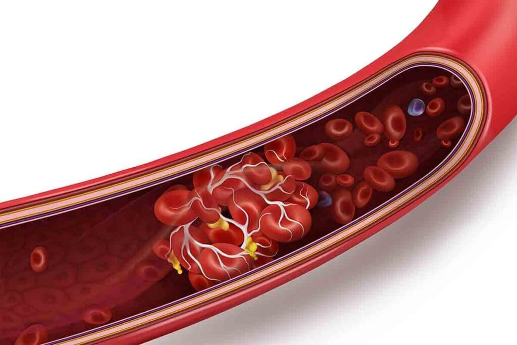 How Long Can You Have DVT Without Knowing and What Are the Warning Signs?