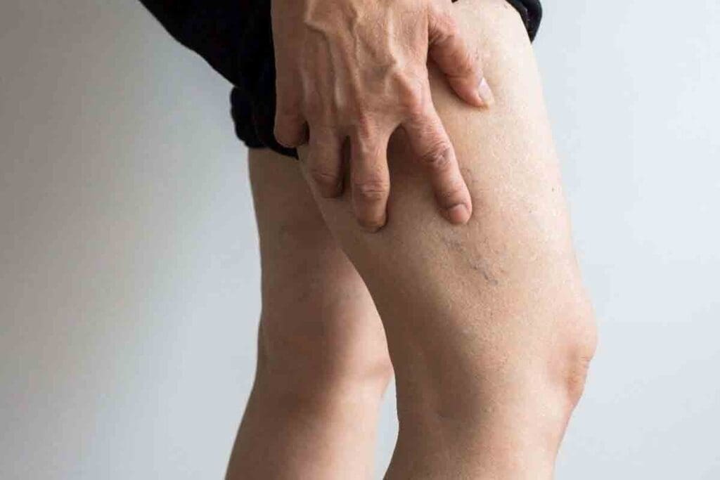 What Causes DVT and How Do Blood Clots Form in the Leg?