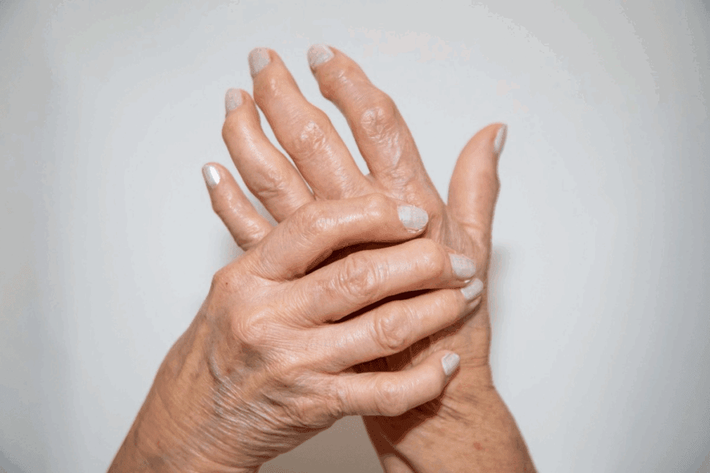 Tips for Living with Psoriatic Arthritis Successfully