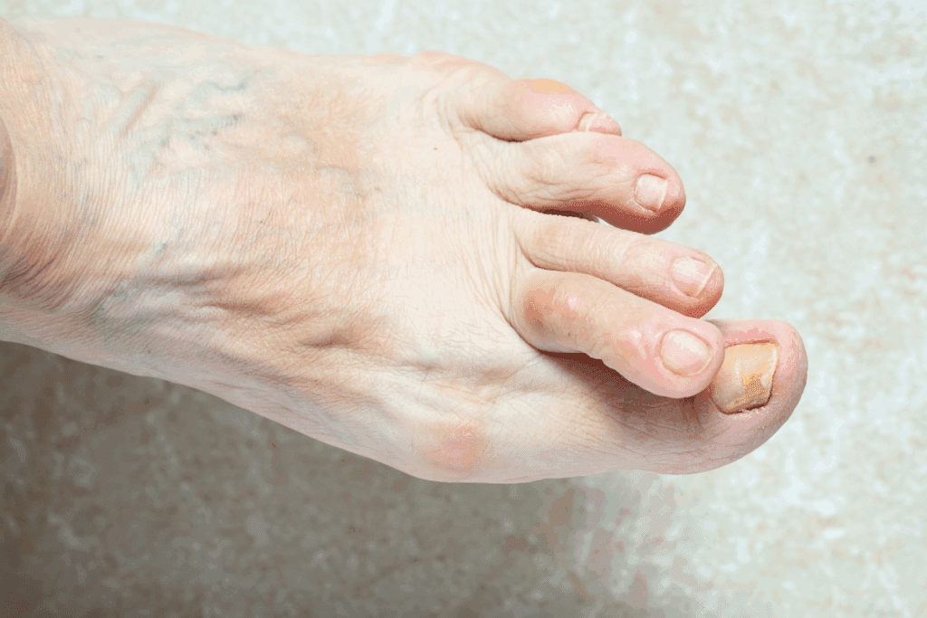 Common Autoimmune Diseases with Psoriatic Arthritis
