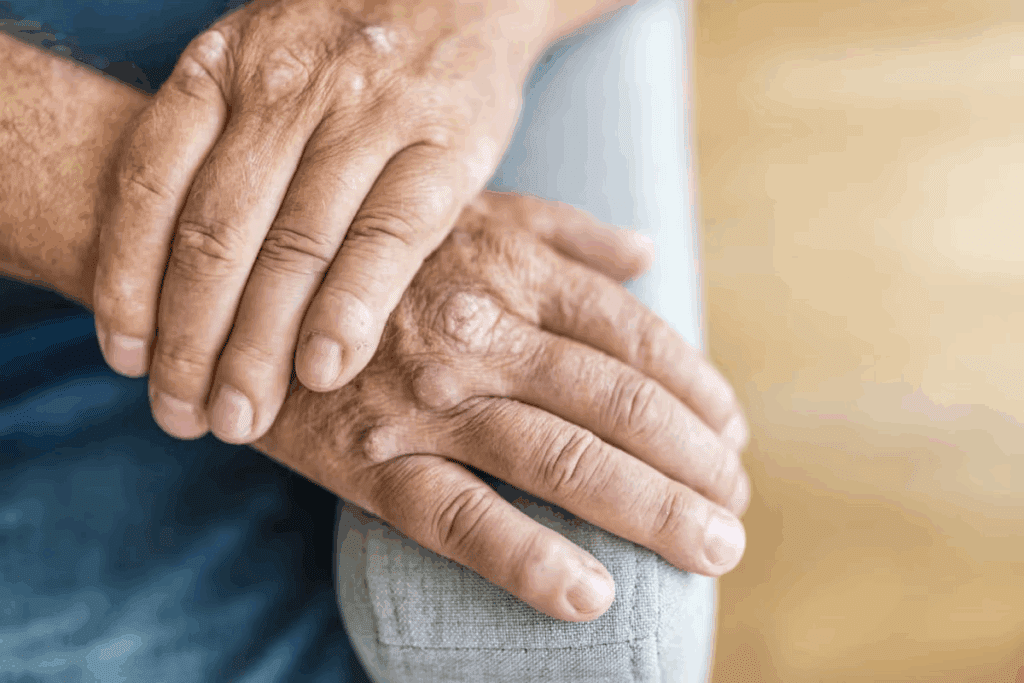 Why Proper Psoriatic Arthritis Treatment Is Crucial 1 Why Proper Psoriatic Arthritis Treatment Is Crucial