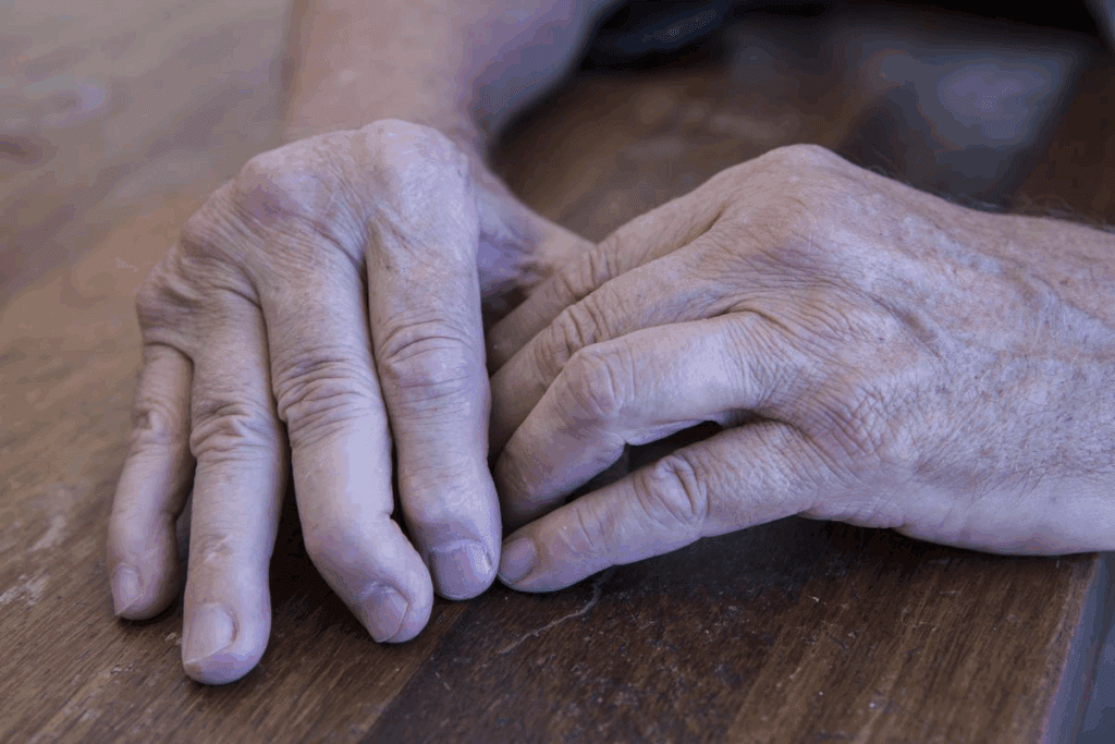 Lupus vs Psoriatic Arthritis: Which Is More Severe?