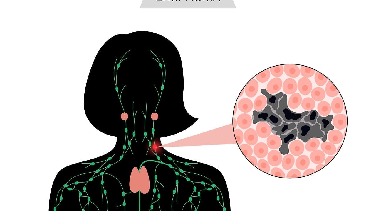 diffuse large b cell lymphoma stage 3 LIV Hospital