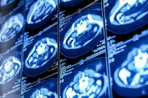 Nuclear Kidney Scan: Procedure & Tips