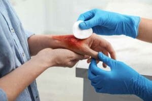 Radiation Burn Victim: 7 Crucial Facts About Types of Burns