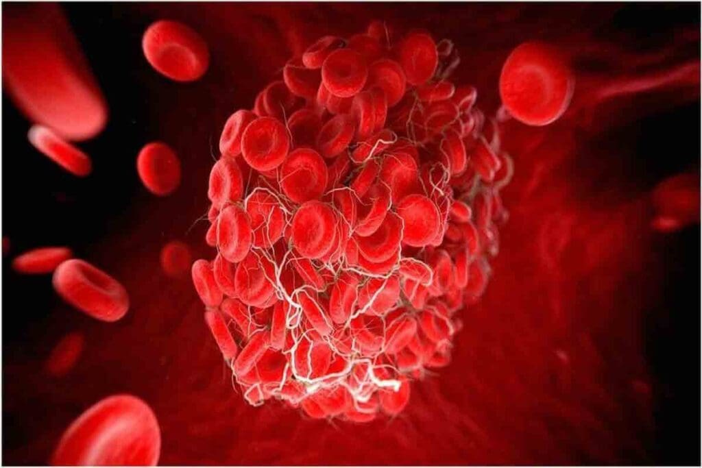 Can You Fly With a Blood Clot? 7 Crucial Travel Safety Tips