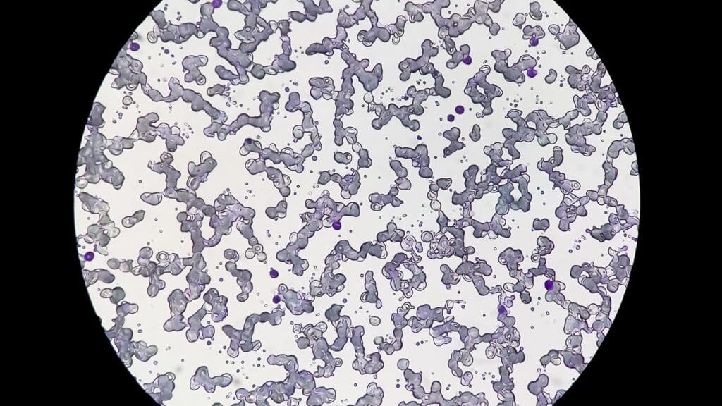 dlbcl stage 4 dlbcl stage 4