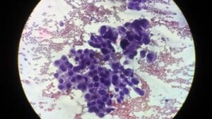 DLBCL Stage 4: 7 Key Facts on Symptoms, Staging, and Treatment