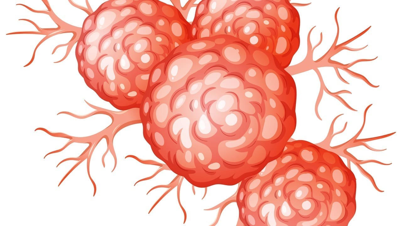 Stage 4 Diffuse Large B Cell Lymphoma: 7 Key Facts and Symptoms