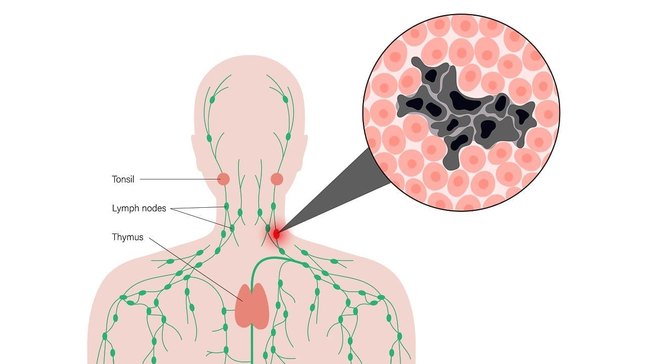 Diffuse Large B-Cell Lymphoma Treatment: 7 Essential Protocols and Regimens