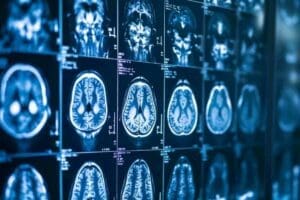 Functional MRI vs PET Scan: The Ultimate Comparison