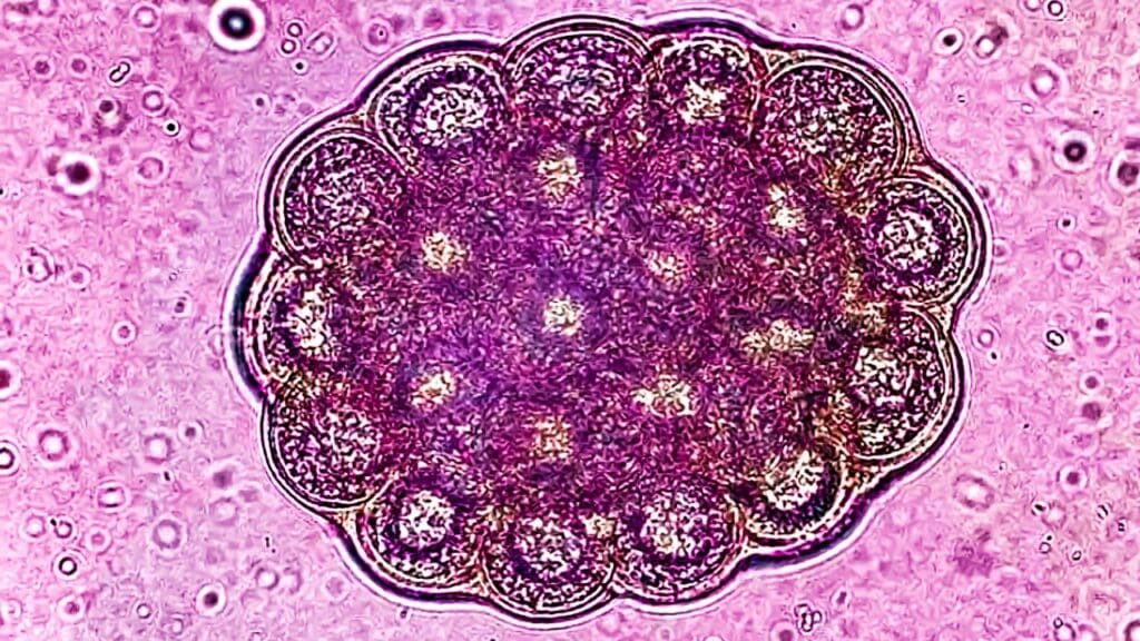 Large B-Cell Lymphoma Large B-Cell Lymphoma