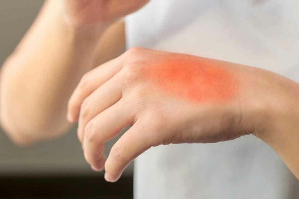 Treatments For Radiation Burns: 7 Essential & Effective Cures 1 Treatments For Radiation Burns: 7 Essential & Effective Cures