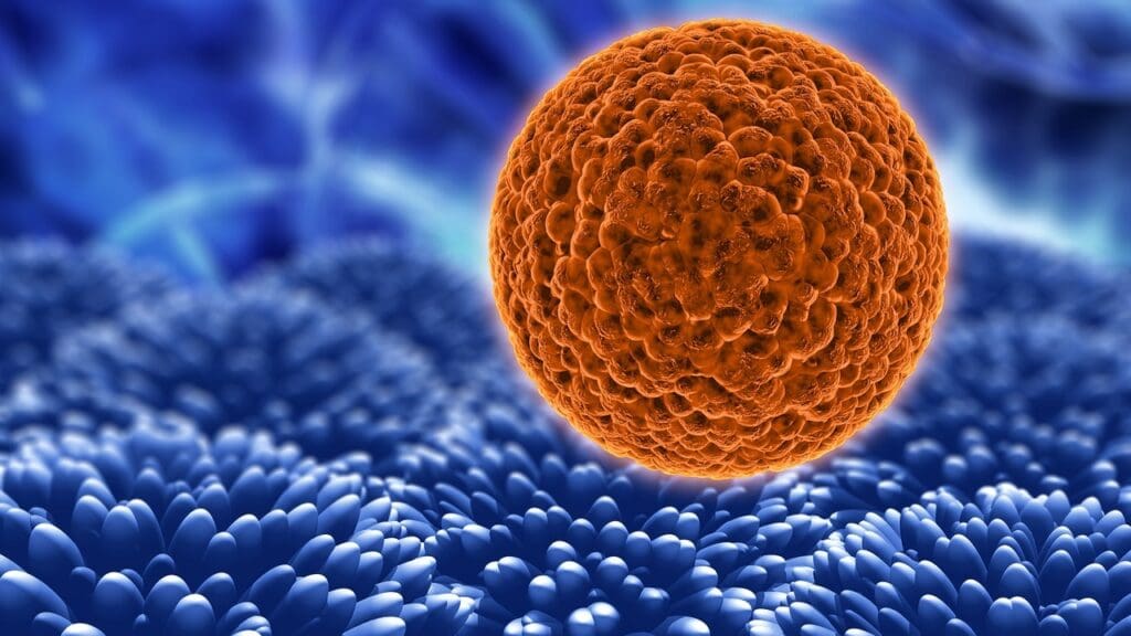 Diffuse Large B Cell Lymphoma Stage 4 Diffuse Large B Cell Lymphoma Stage 4