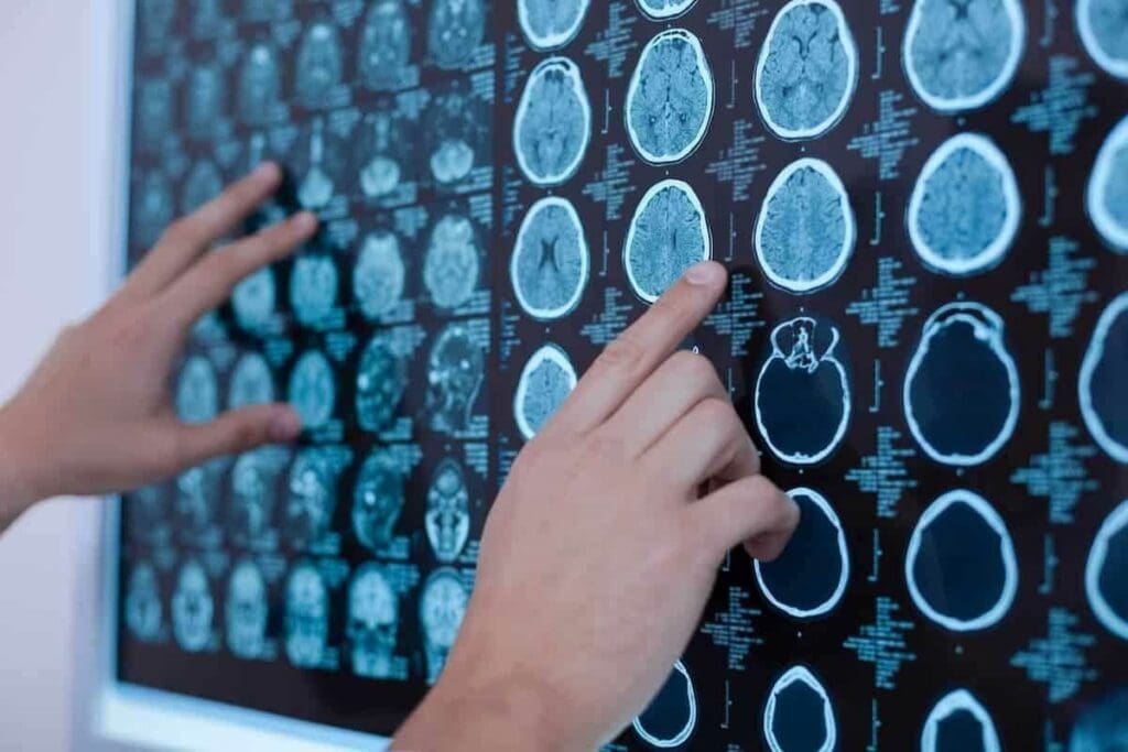 3 Key Facts About Brain Cancer X Ray: Uses & Diagnosis