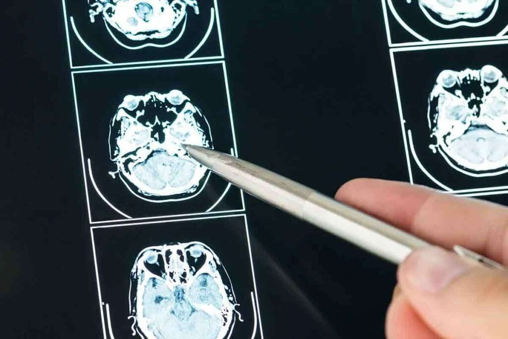 MRI Scan Brain Cancer: 7 Key Facts About Detection and Diagnosis